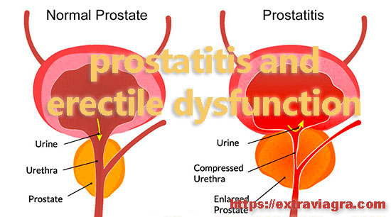 prostatitis and erectile dysfunction